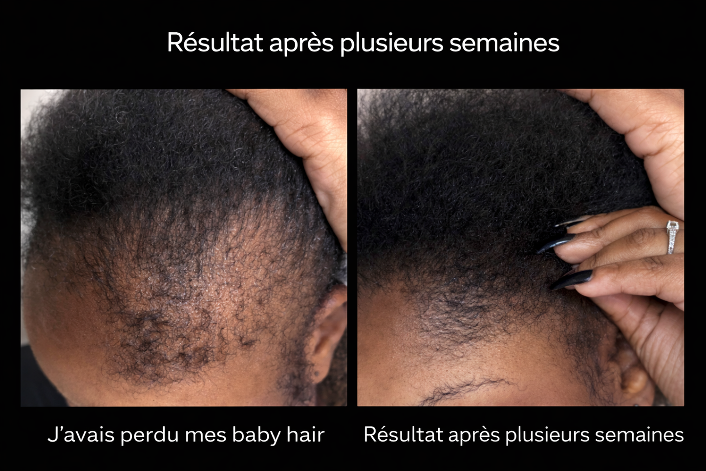Huile anti-chute & repousse – Baby hair visibles dès 3–6 semaines